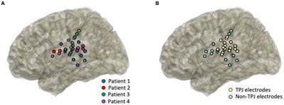 Intracranial recordings reveal high-frequency activity in the human temporal-parietal cortex supporting non-literal language processing